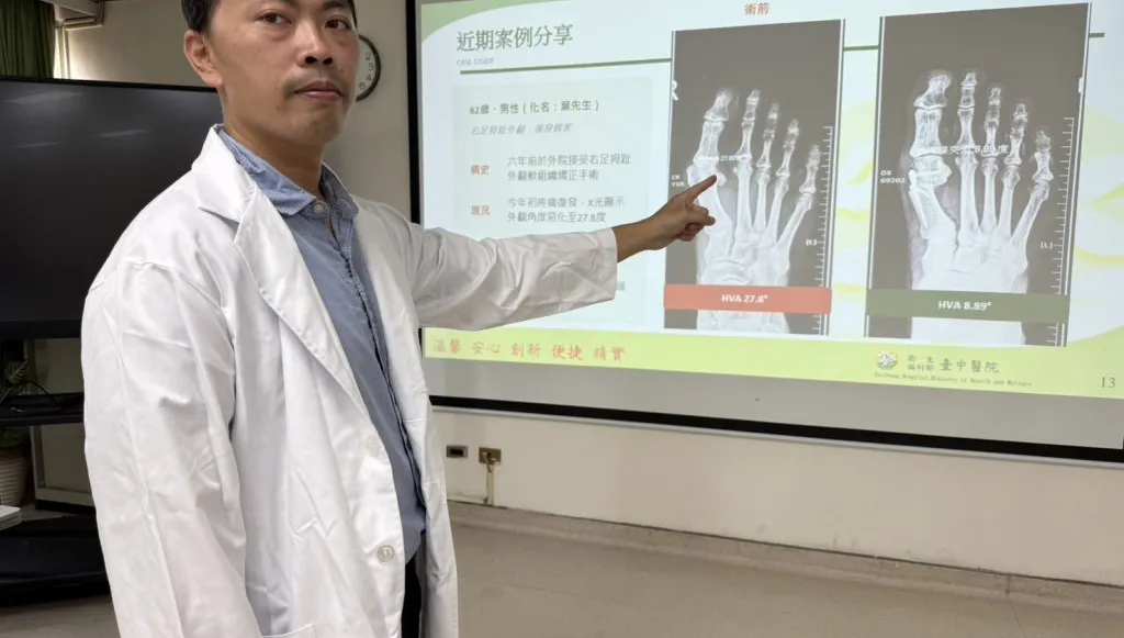 登山男6年兩度拇指外翻    醫師用這手術改善惱人症頭