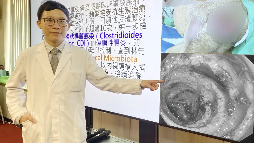反覆腹瀉久治不癒 中榮用糞菌移植助患者重建腸道健康