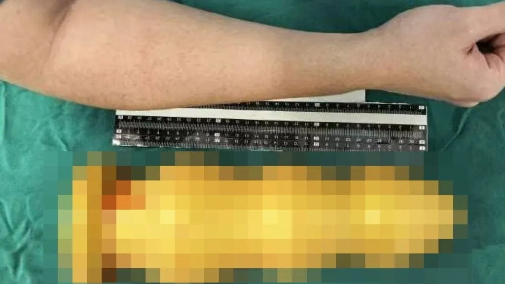 不小心？59歲男直腸塞進28公分異物頂到肺　醫師爆：上次是南瓜