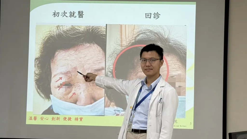 婦眼角冒水皰竟是「皮蛇」入侵！ 醫療團隊即時診治化解危機