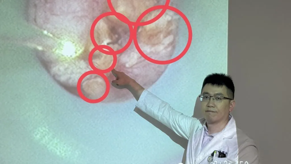 她的腎臟像長滿葡萄乾的雜糧麵包！  原來是「雷氏斑」作祟
