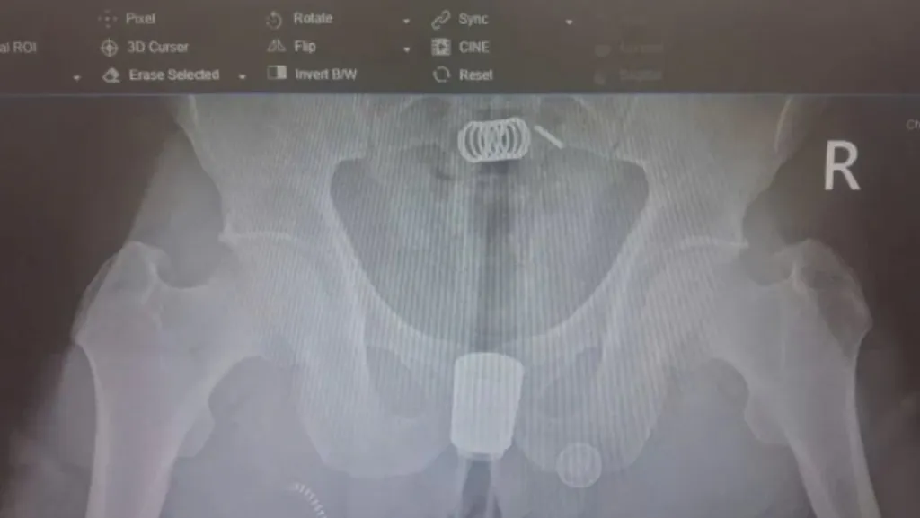 男把沖洗器塞體內卡住！X光曝光　醫急開刀救命