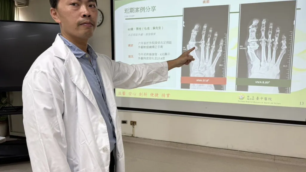 登山男6年兩度拇指外翻 醫師用這手術改善惱人症頭