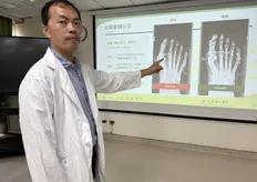 登山男6年兩度拇指外翻 醫師用這手術改善惱人症頭