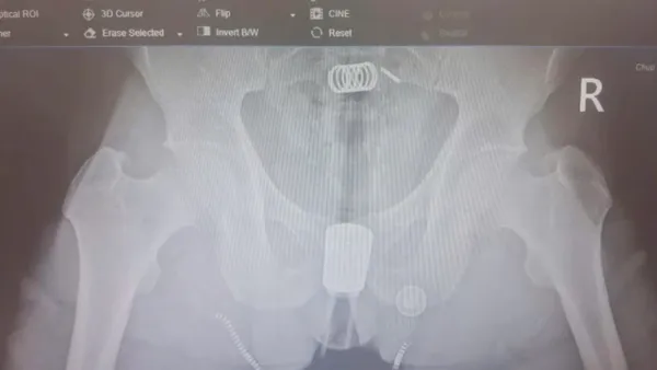 深入體內20公分!越南男塞「馬桶沖洗器」扳機卡直腸 醫耗時2小時驚險取出