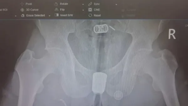 男把沖洗器塞體內卡住！X光曝光　醫急開刀救命