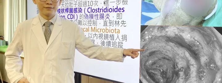 反覆腹瀉久治不癒 中榮用糞菌移植助患者重建腸道健康